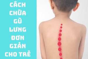 Cách chữa gù lưng đơn giản cho trẻ